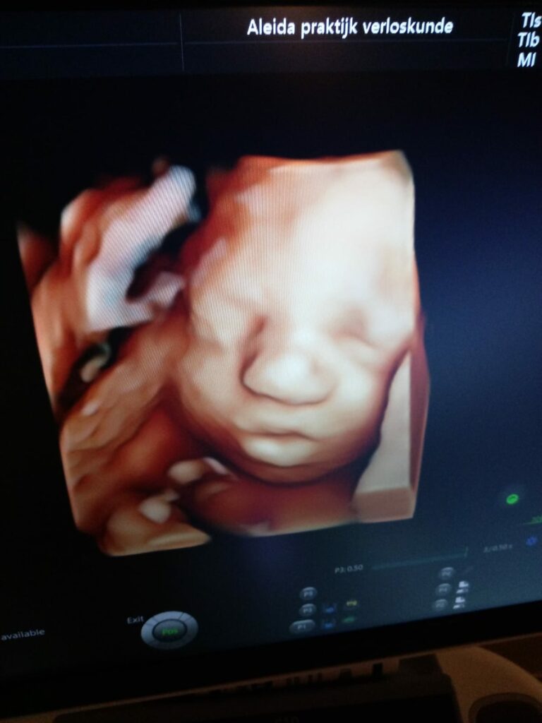 3D echo baby 30 weken, babylabel