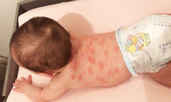 Constitutioneel eczeem