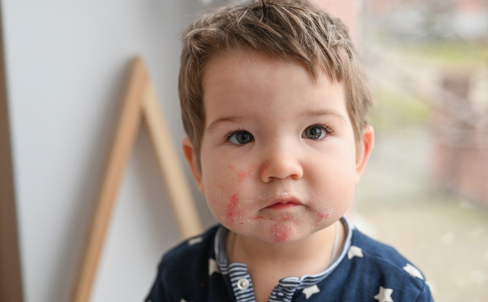 Voeding kan leiden tot allergiesymptomen bij baby’s, allergie bij baby's, symptomen allergie baby, voedingallergie baby, voedselallergie baby, voedingsallergie