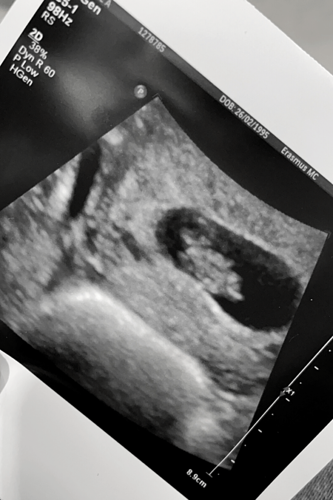 echo, echo 12 weken, zwangerschapscontrole, zwanger
