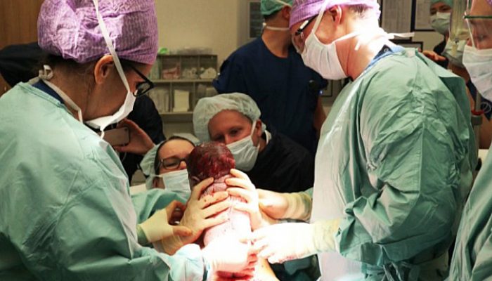 keizersnede, helpen bij keizersnede