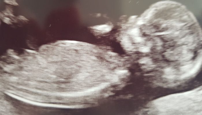 zwanger na een miskraam, babylabel, 18 weken zwanger, baby